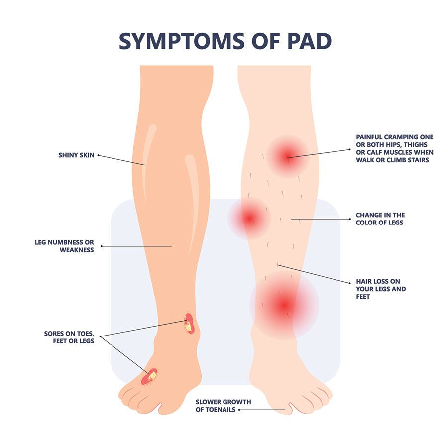 PAD Symptoms, Fairfax Vascular Center